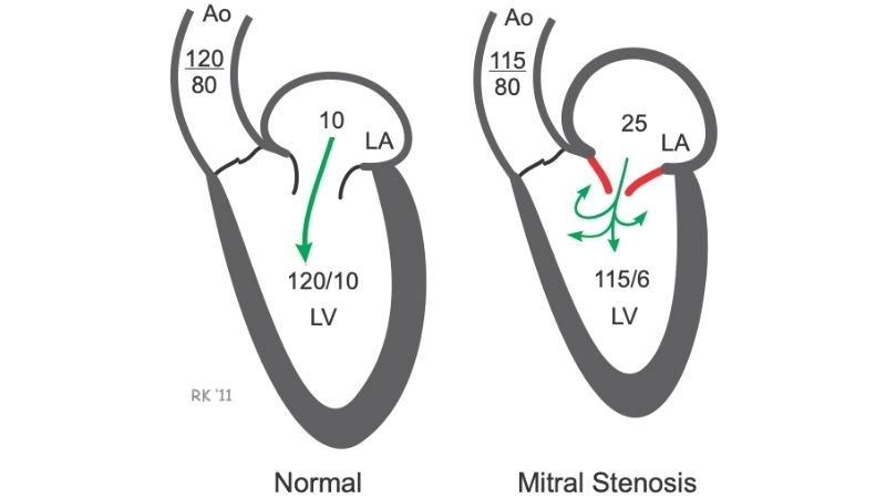Mitral Valve Stenosis Life Expectancy depends on care
