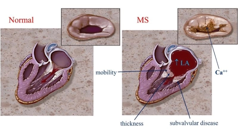 Rheumatic Mitral Stenosis common cause in young adults
