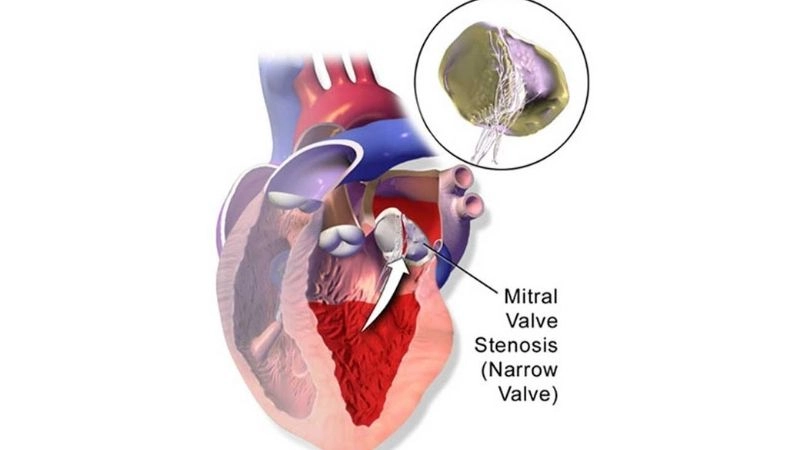 Mitral Stenosis Guidelines provide clinical management steps