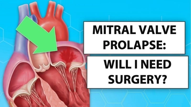 Mitral Valve Prolapse Diet supports better heart health