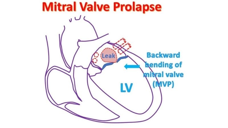 Mitral Valve Prolapse And Anxiety often occur together