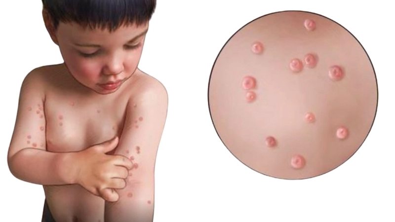 Molluscum Contagiosum natural remedies