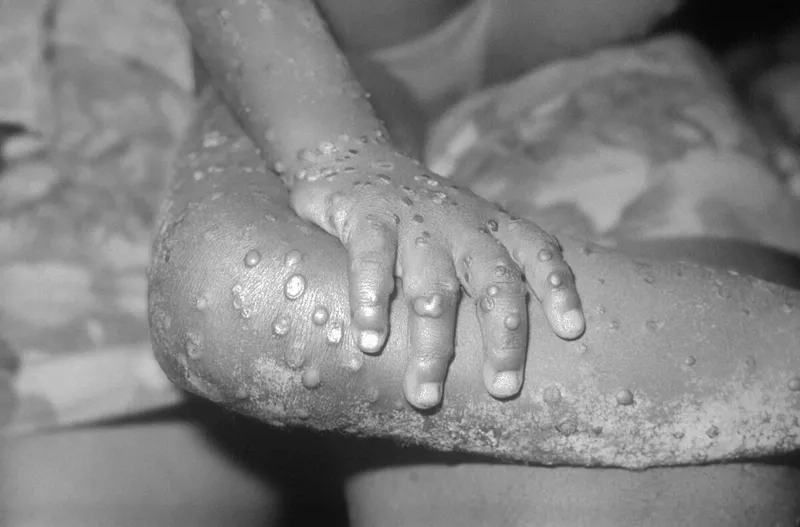Exploring the evidence: is mpox an STD