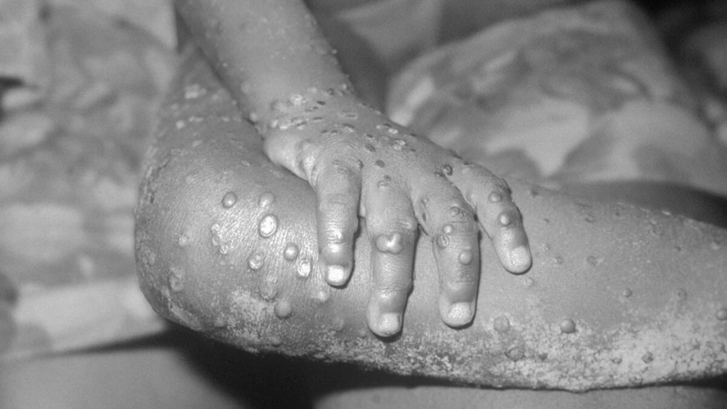 Mpox (formerly Monkeypox) needs mPox vaccine now