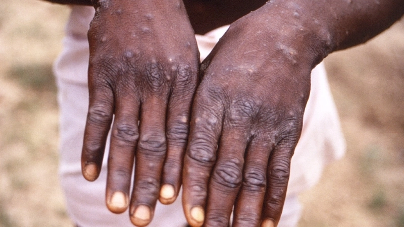 Mpox (formerly Monkeypox) spreads mPox transmission ways