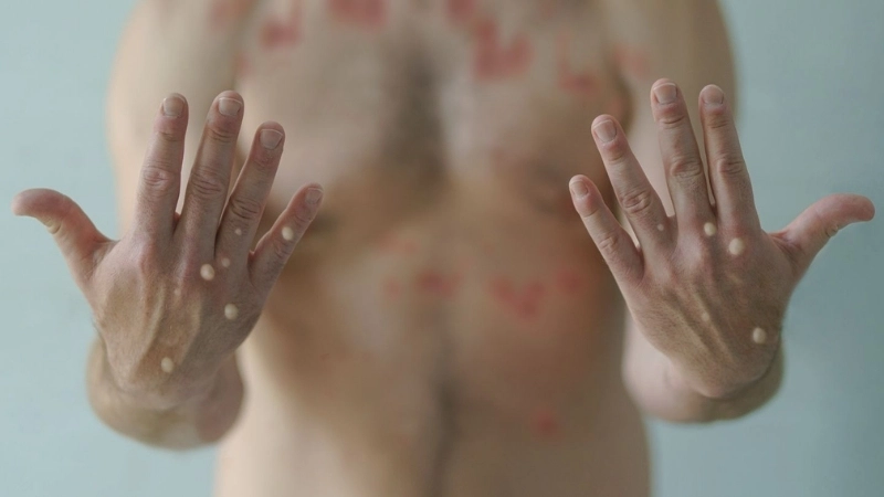 Mpox (formerly Monkeypox) asks is mPox deadly today