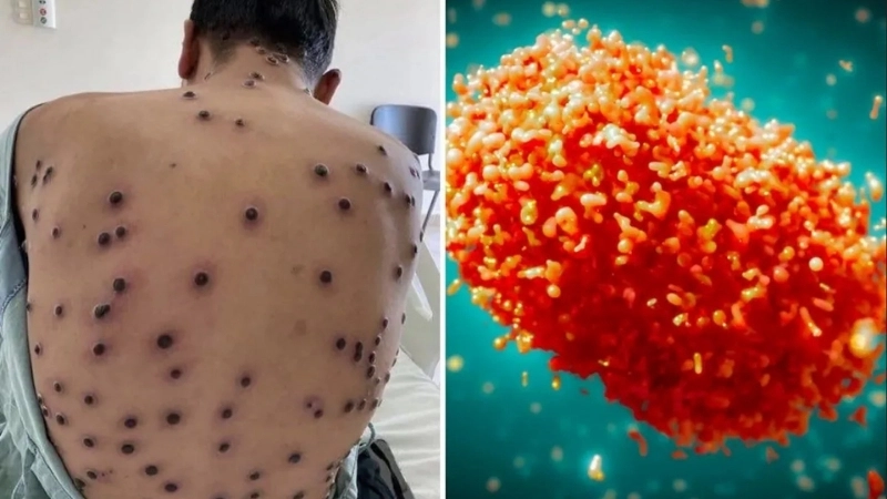 Mpox (formerly Monkeypox) ensures mPox prevention tips