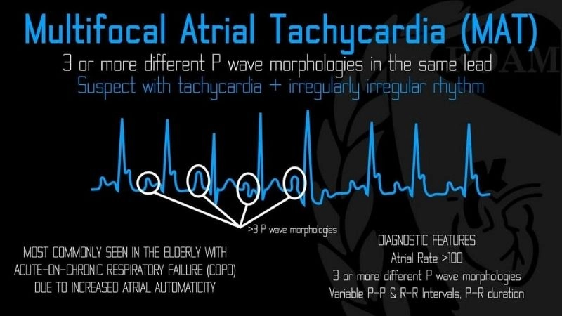 Multifocal Atrial Tachycardia ECG reveals multiple signals