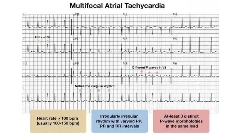Chaotic Atrial Tachycardia rare and complex arrhythmia