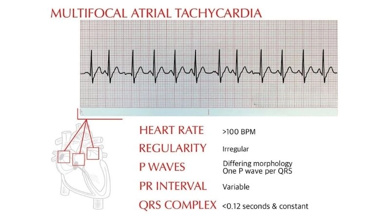 Multifocal Atrial Tachycardia Prognosis depends on condition