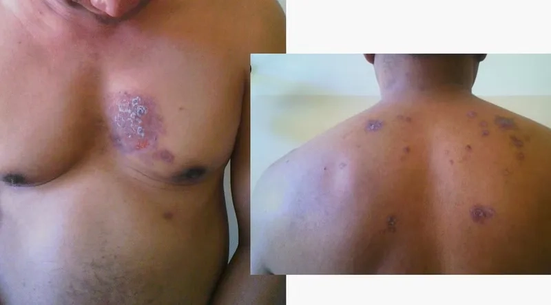 Is multiple myeloma curable and treatment options