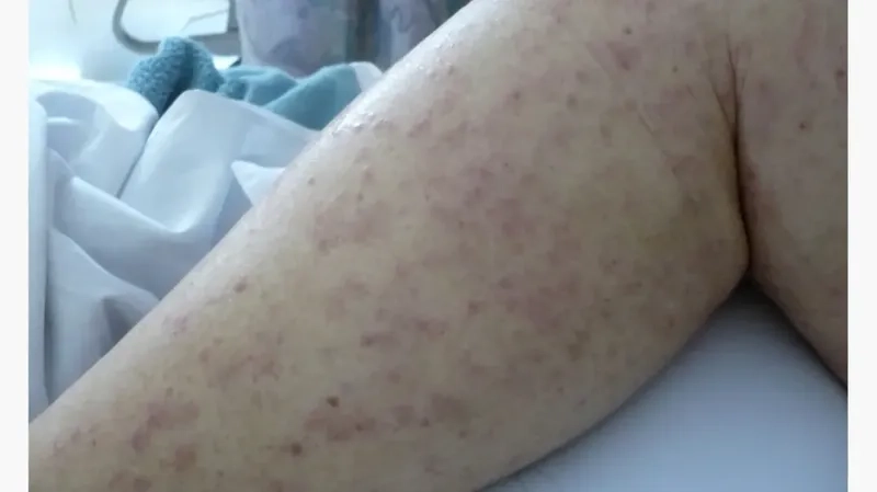 Multiple myeloma stages and disease progression