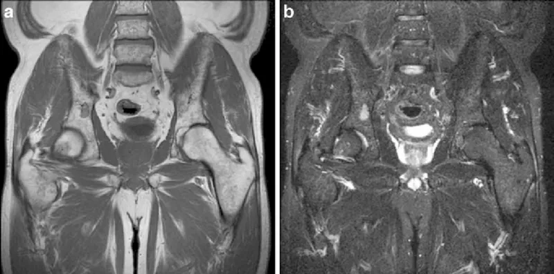 Multiple myeloma diagnosis and medical process