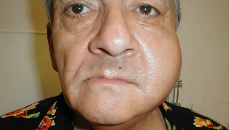 Benefits of the mumps rubella measles vaccine