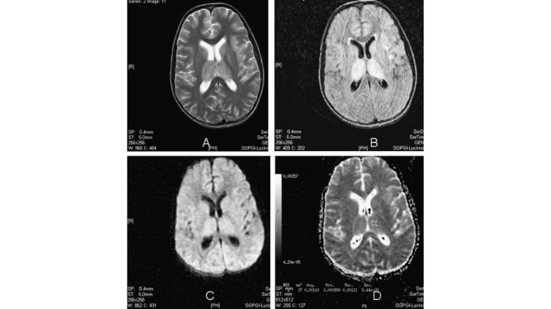 Murray Valley Encephalitis is dangerous viral encephalitis