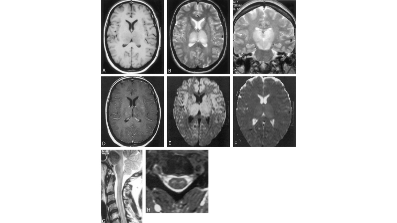Murray Valley Encephalitis known as Australian encephalitis