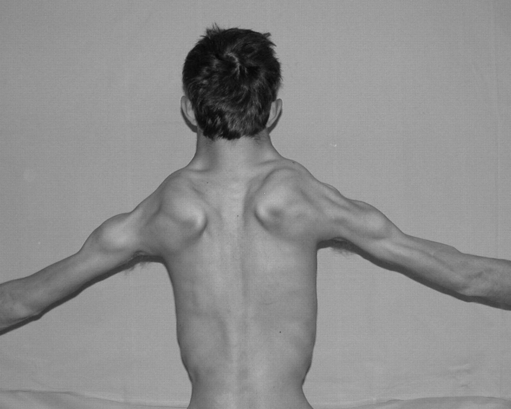 Physical therapy session for a patient with muscular dystrophy