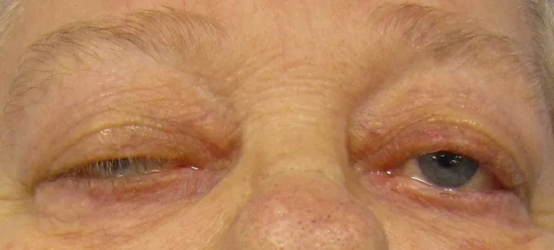 Guide to myasthenia gravis treatment options