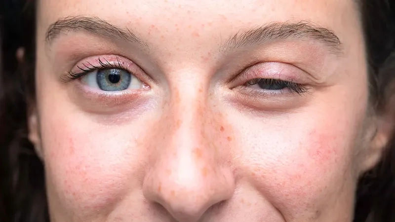 Illustration of an autoimmune neuromuscular disease pathway