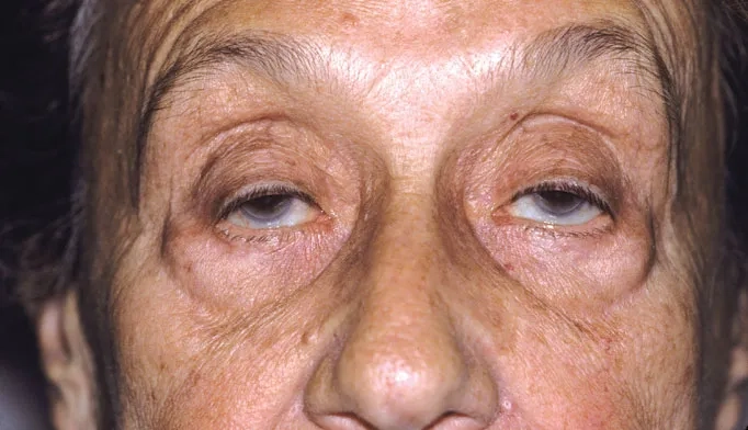 Medical team responding to a myasthenic crisis