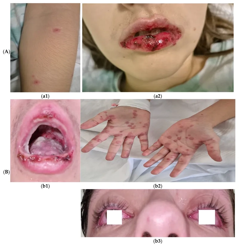 Clinical image of a Mycoplasma pneumoniae rash