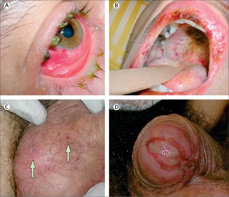 Chest X-ray indicating signs of atypical pneumonia