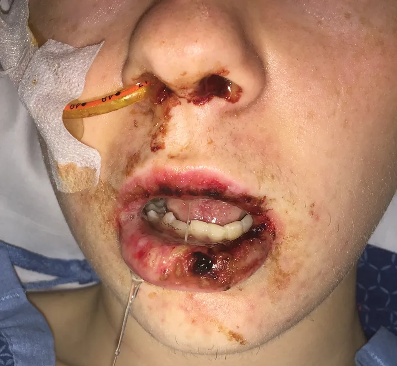 Common antibiotics for walking pneumonia treatment