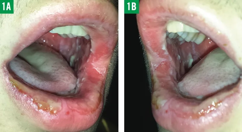 Administering treatment for Mycoplasma pneumoniae
