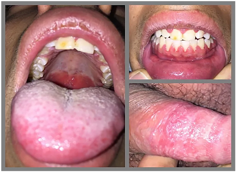 Lab results for diagnosis of Mycoplasma pneumoniae