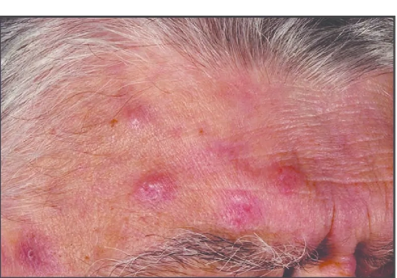 MDS treatment options illustrated in hospital treatment room