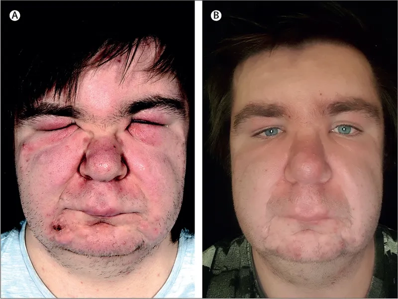 MDS vs leukemia comparison in medical diagnostic imaging