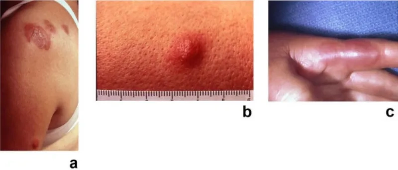 MDS diagnosis process shown in laboratory blood analysis