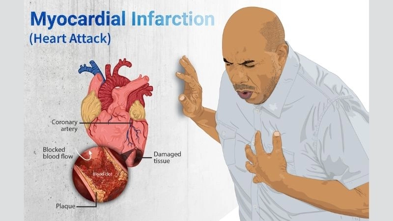 Emergency cases of acute myocardial infarction