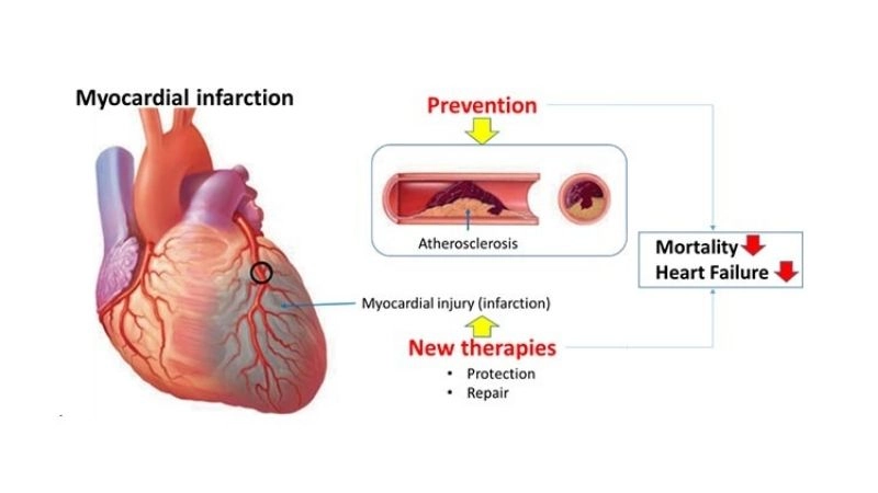 Medical terms define myocardial infarction today