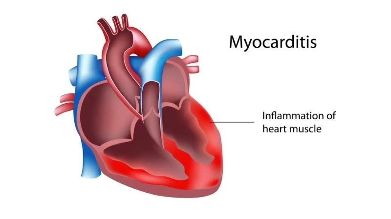 Myocarditis causes underlying triggers of this cardiac condition