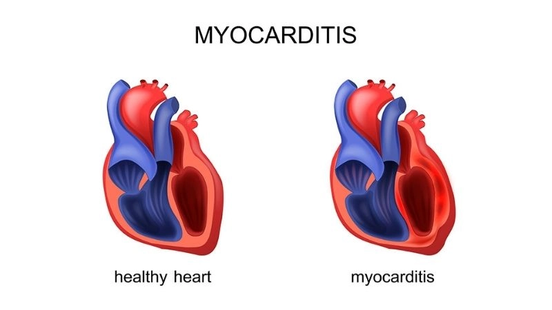 Myocarditis recovery time healing duration after diagnosis
