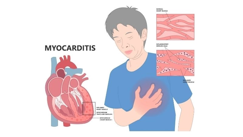 Myocarditis in children rare but serious pediatric heart issue