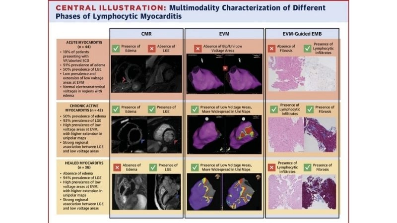 Viral myocarditis infection induced inflammation of the myocardium