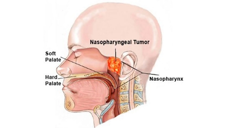Early Nasopharyngeal Carcinoma relates to nasopharyngeal cancer