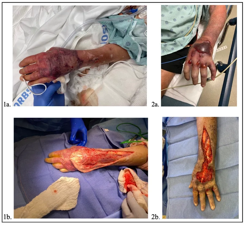 Visual guide to necrotizing fasciitis symptoms