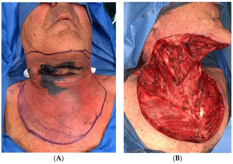 The process of life-saving necrotizing fasciitis surgery
