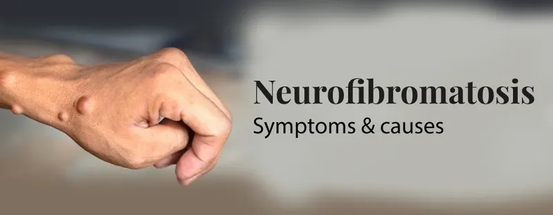 Neurofibromatosis type 1 and its clinical features