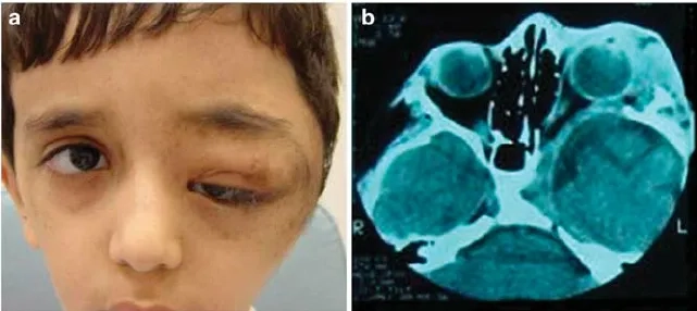 Neurofibromatosis type 2 and related conditions