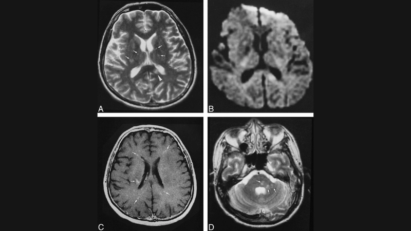 Effective Nipah virus encephalitis treatment options