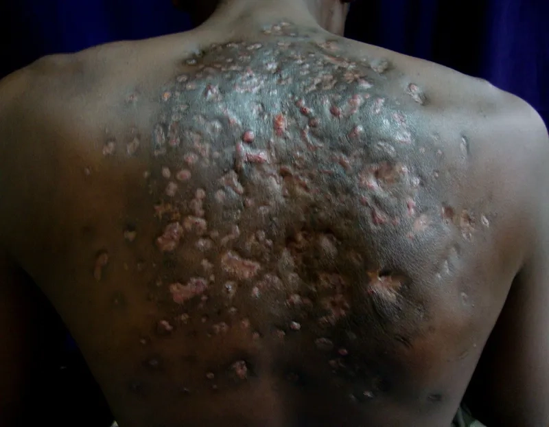 A close-up image of a cutaneous nocardiosis lesion