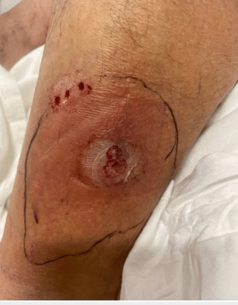 Microscopic view of a Nocardia infection