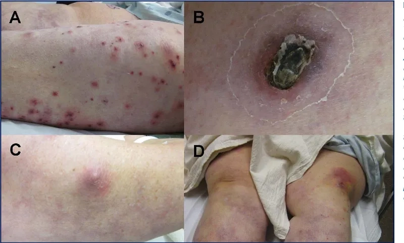 An infographic explaining what is nocardiosis
