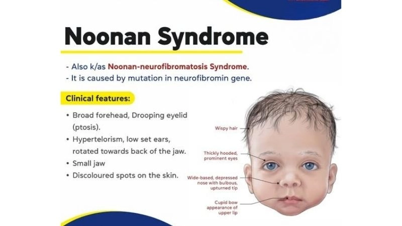 Noonan syndrome treatment options explained