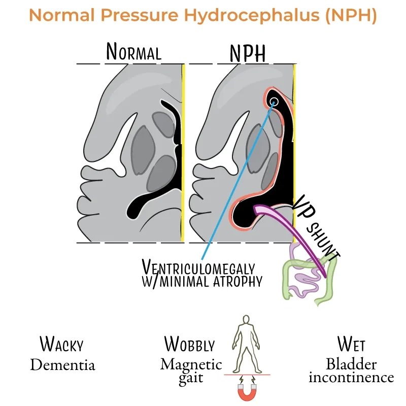 A guide to normal pressure hydrocephalus symptoms