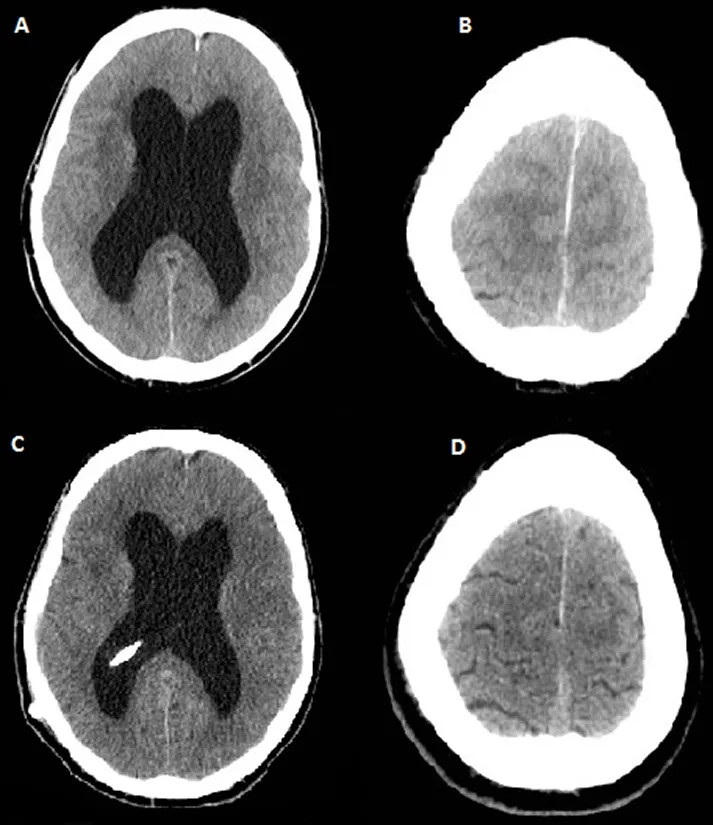A diagram of a ventriculoperitoneal shunt